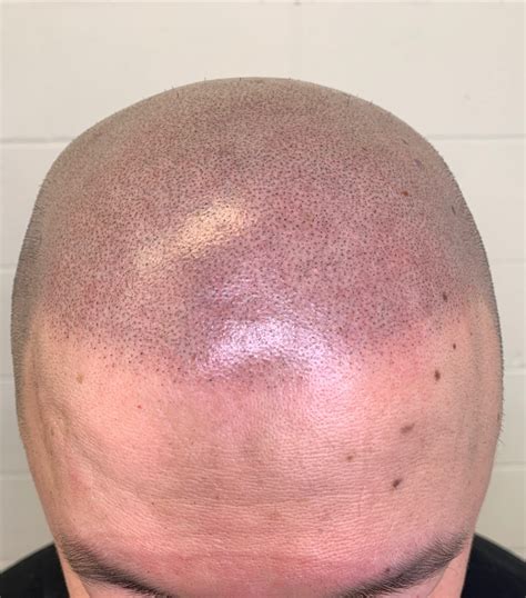 Are there any side effects to Scalp Micropigmentation? - Vancouver ...