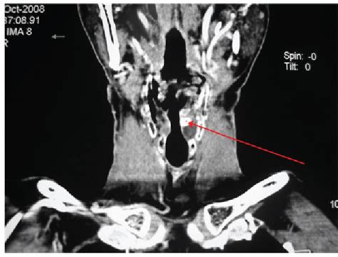 Figure 4 From Laryngeal Function Reconstruction With Hyoid