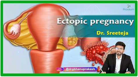 Ectopic Pregnancy Etiology Clinical Features Diagnosis Treatment