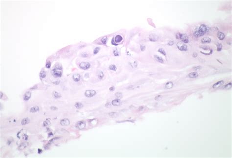 Atlas Entry Acanthamoeba Keratitis