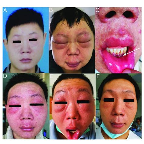 Facial Features Of The Patient With Nktcl A Two Years Before