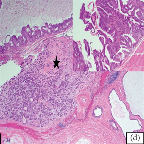 A Moderately Differentiated Adenocarcinoma Involving Cores Of Fibrous