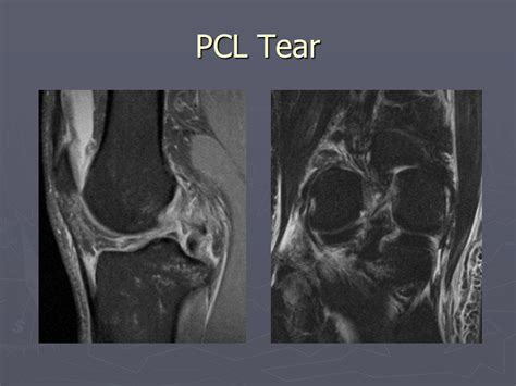 Acl Tear no longer seen On Mri - Kazetani6Reisa