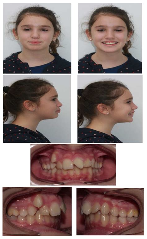 Applied Sciences Free Full Text Herbst Appliance Reinforced With An Hybrid Hyrax Expander