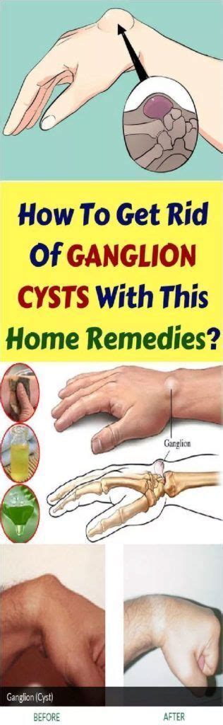 How To Get Rid Of Ganglion Cysts With This Home Remedies Wellness Days