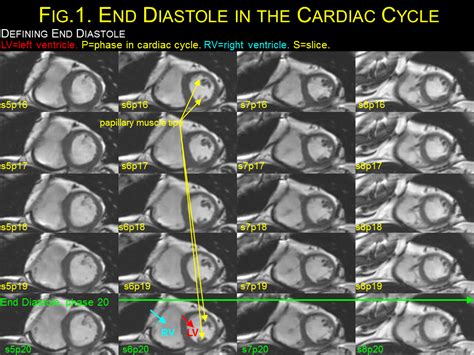 End Diastolic Volume Index Cardiac Mri