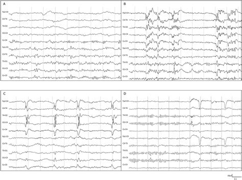 Evolution Of Eeg Patterns In Cerebral Reperfusion Syndrome After Carotid Artery Stenting