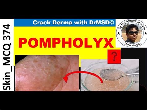 Dyshidrotic Eczema Pompholyx Causes Symptoms Diagnosis