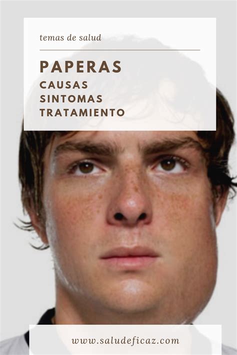 Paperas Causas Sintomas Y Tratamiento