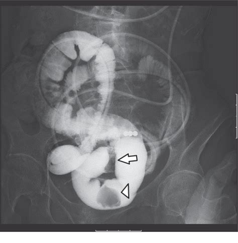 A Case Of Gallstone Ileus Treated By Single Port Laparoscopic Surgery