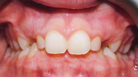 Class Ii Division 1 Malocclusion Excessive Overjet Deep Overbite Case Gallery