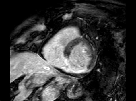 Cardiac Infarction With Fat Free Mdixon Imaging Philips Mr Body Map