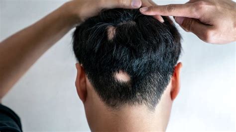 How To Stop Alopecia Areata From Spreading This Non Invasive Solution