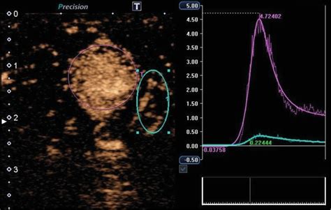 Multiparametric Ultrasound Mpus Of A Rare Testicular Capillary