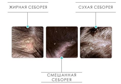 Себорея. Лечение себореи средствами народной медицины