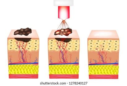 Removal Birthmarks Popiloma Wart Laser Structure 스톡 일러스트 1278240127