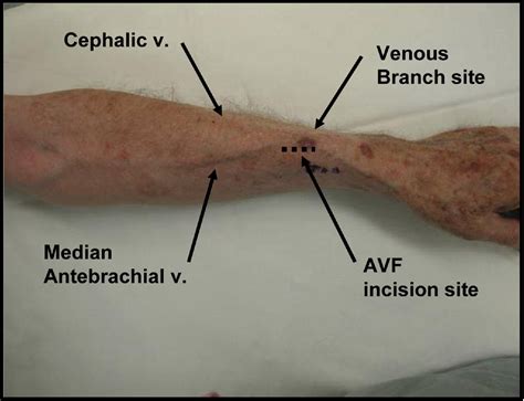 Creating Radiocephalic Arteriovenous Fistulas Technical And Functional