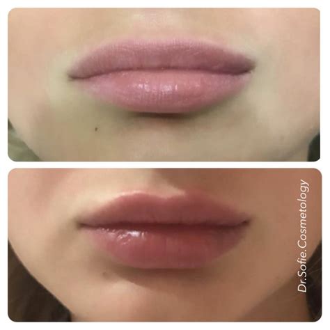 Увеличение губ | Facial aesthetics, Botox, Face