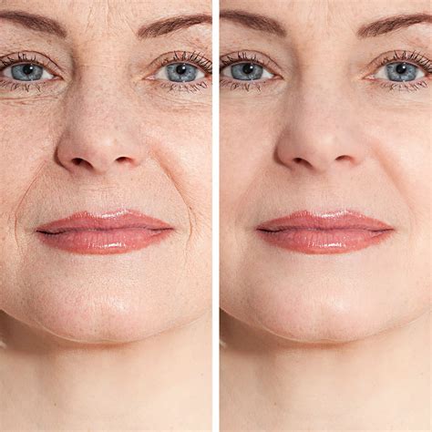 Restylane Refyne Injectable Fillers In Santa Rosa And Healdsburg