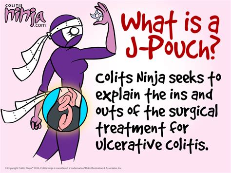 J Pouch Important Things You Need To Know Infographics