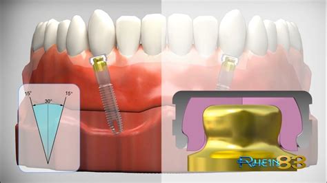 Ot Equator Implant Retained Overdenture Attachment Youtube