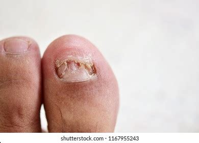 Subungual Hematoma Present Under Toenail Hallux Foto Stock 1919686037