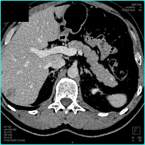 Mm Pancreatic Neuroendocrine Tumor Pnet In The Tail Of The Pancreas