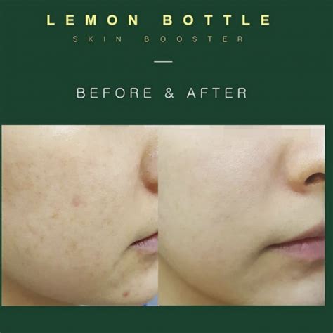 Lemon Bottle Skin Booster - 6x3.5ml