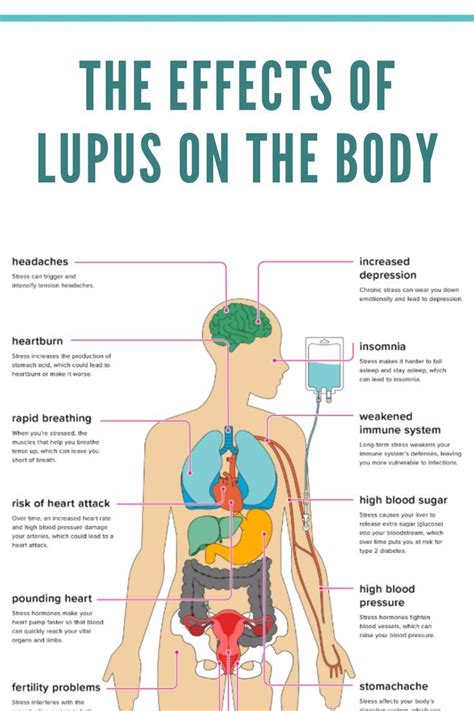 LUPUS FOUNDATION: "The Kidneys are The Most Commonly Affected Organ in Lupus Nephritis"