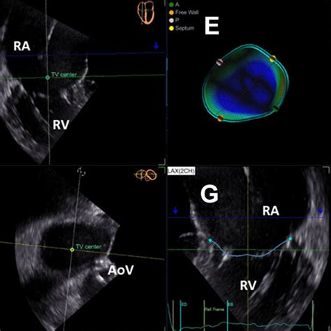 Modelling The Tricuspid Valve From 3 Dimensional Transesophageal