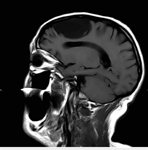 Magnetic Resonance Imaging Showing A Large Left Frontal Arachnoid Cyst