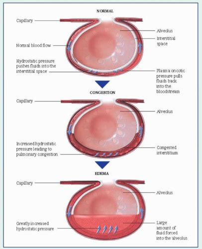 Cardiogenic And Non Cardiogenic Pulmonary Edema Flashcards Quizlet