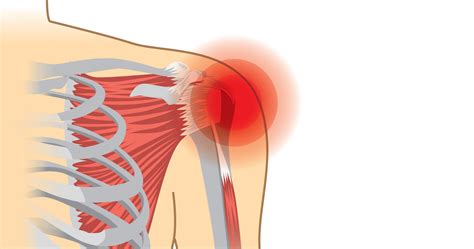 How a Torn Rotator Cuff is Repaired - High Mountain Orthopedics