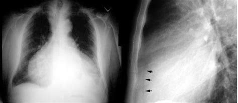 Medic Guide On Chest X Ray How Do I Distinguish A Pericardial