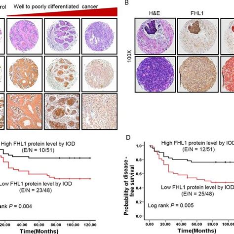 Patterns of FHL1 gene expression were investigated in 101 specimens of ... 