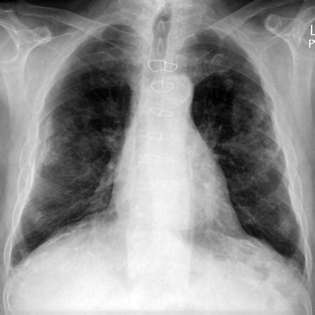 Mesothelioma Pleural Plaques / Asbestos Related Pleural Plaques ...