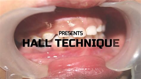 Hall Technique I Stainless Steel Crown I Pediatric Dentistry Youtube