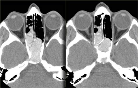 The Best 11 Fungal Sinusitis Ct Pns Factdrivecolor