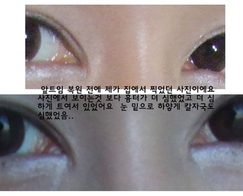 수술후기 앞트임흉터 And 복원 때문에 고생하시는 분들 위해 후기 써요 앞트임 재건 앞트임 흉터 앞트임 복원