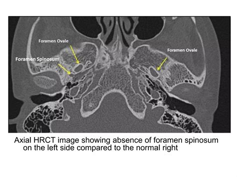 Interventional Neuroradiology: Anatomy of the internal carotid artery (ICA) | PPT