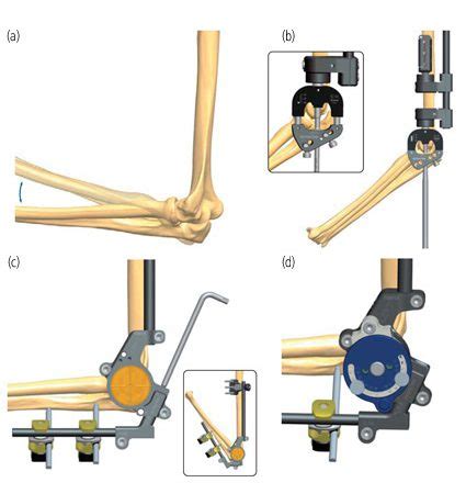 Stiff Elbow Treatments Orthofix Abs