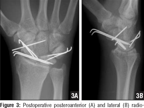 Figure 2 From Total Volar Extrusion Of The Lunate And Scaphoid Proximal