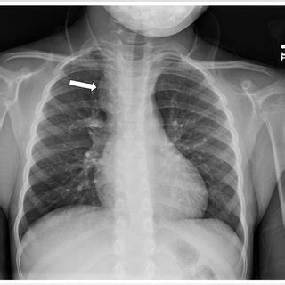 Posterior Anterior Chest Radiography Demonstrating Pulmonary Sexiz Pix