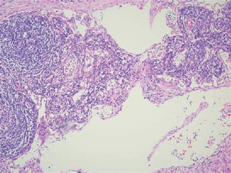 Figure 1 From Cystic Lymphangioma Of The Pancreas Semantic Scholar