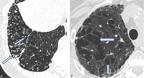 Lungs Radiology Key