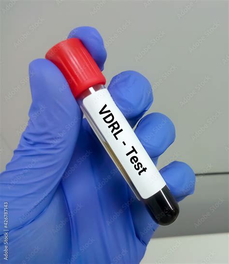 O Que Significa Vdrl - Blood sample tube for VDRL ( venereal disease research laboratory) test ...
