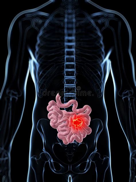 Male Small Intestine Cancer Stock Illustration Illustration Of