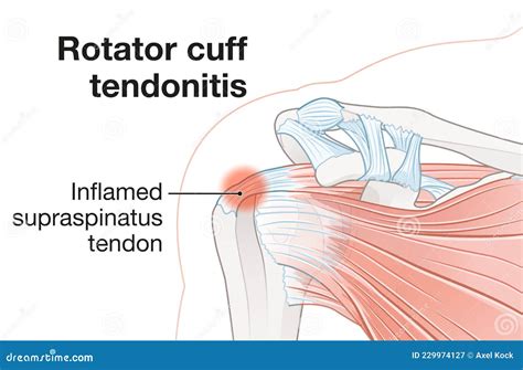 Shoulder Anatomy Rotator Cuff Tendonitis Stock Illustration