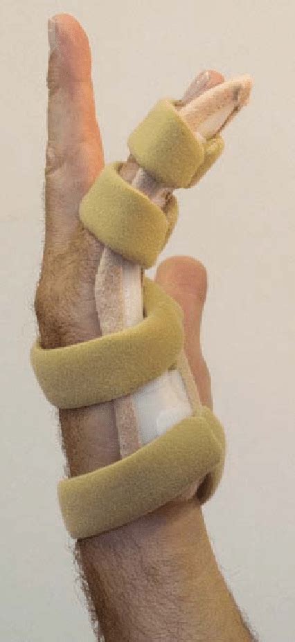 3 Composite Extension Splinting At 3 Weeks A Nighttime Volar