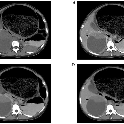 Preoperative Abdominal And Contrast Enhanced Ct Images A Abdominal Download Scientific